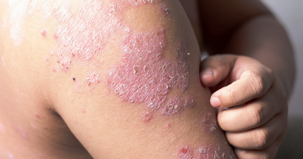 Santé : six biomédicaments innovants pour traiter l’eczéma, mais à qui s’adressent-ils ?