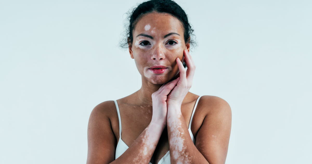 Qu’est-ce que le vitiligo, la maladie de la peau dont souffrait Michael Jackson ?