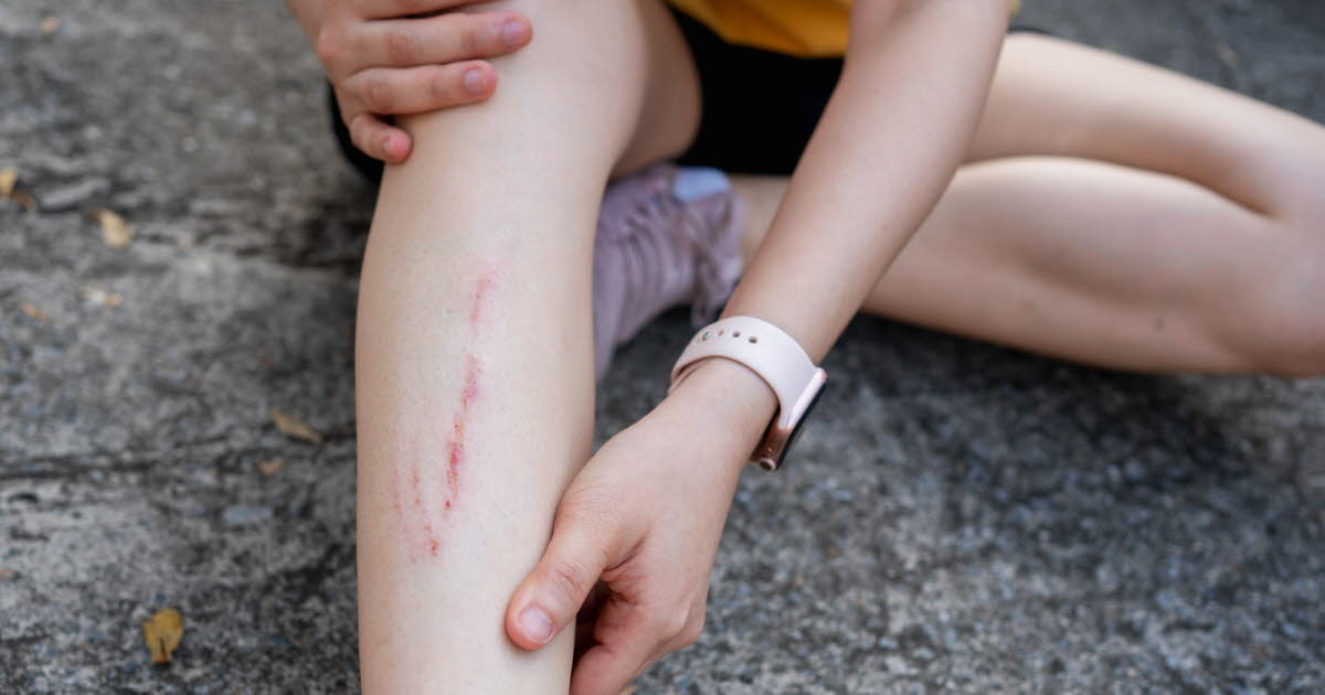 Pourquoi les plaies qui cicatrisent démangent-elles ?